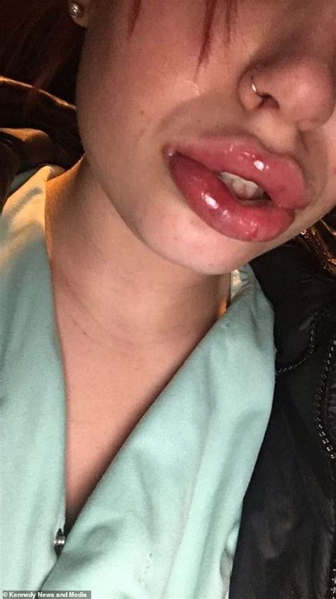Teen Spent A Week In Hospital And Was Left With Deformed Sausage Lips