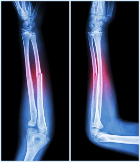 Facts You Must Know About Bone Fractures Vrogue Co