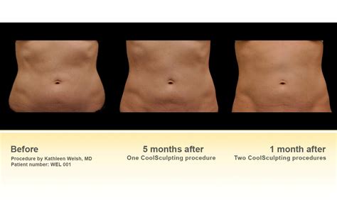 Winter Slimming With Coolsculpting