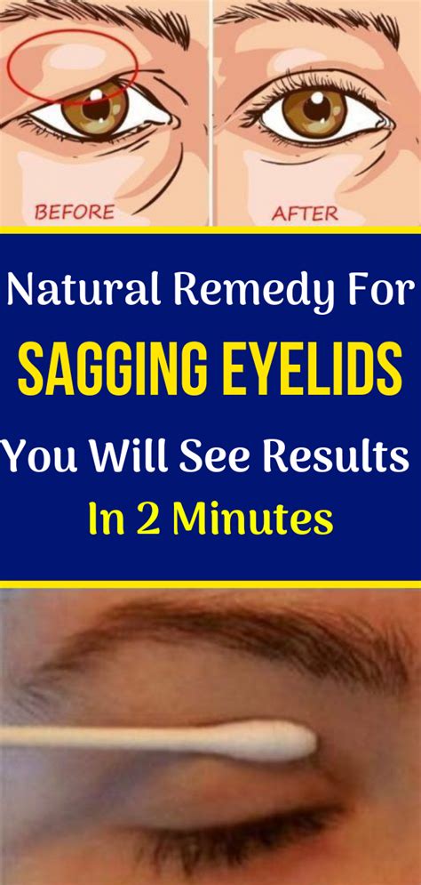 Herbal Medicine Natural Remedy For Sagging Eyelids You Will See