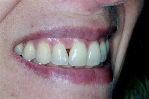Black Triangle Teeth Treatment In Mendham Nj