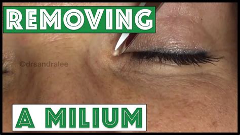 How To Remove Milia Eye Howtorem