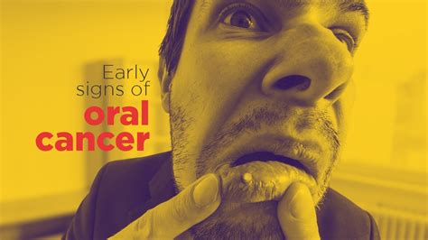 How To Check Your Mouth For Cancer Oral Cancer Youtube