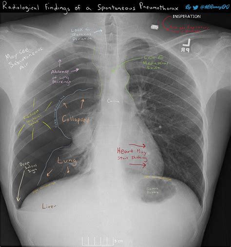 Radiographical Findings In Spontaneous Pneumothorax Grepmed