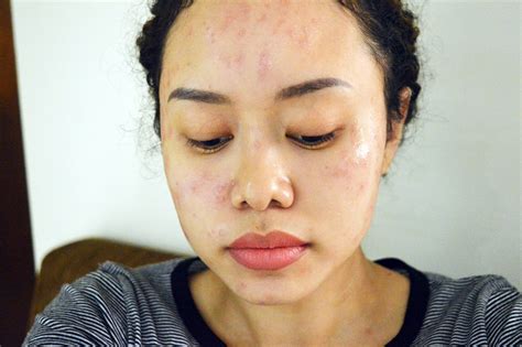 Trulum revolutionizing skincare industry, denpasar, indonesia. Erha Before After - Blog Kesehatan Anda