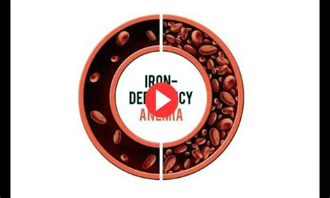 Iron Deficiency Anemia All You Need To Know