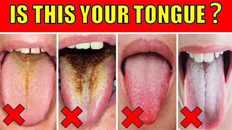 What Your Tongue Reveals About Your Health Epic Natural Health