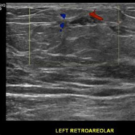 Ultrasound Image Of Left Retroareolar Mass Download Scientific Diagram