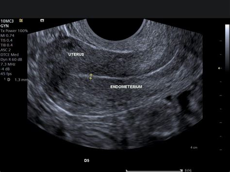 understanding pelvic ultrasound reports pelvic ultrasound results explained