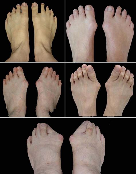 This Picture Illustrates Various Degrees Of Bunion Deformity From Mild
