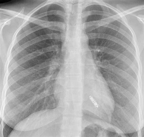 Crt, cardiac resynchronization therapy) are discussed in subsequent chapters. Pacing supplement: Leadless pacing - The British Journal ...