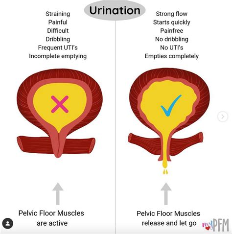 What Is Urinary Retention