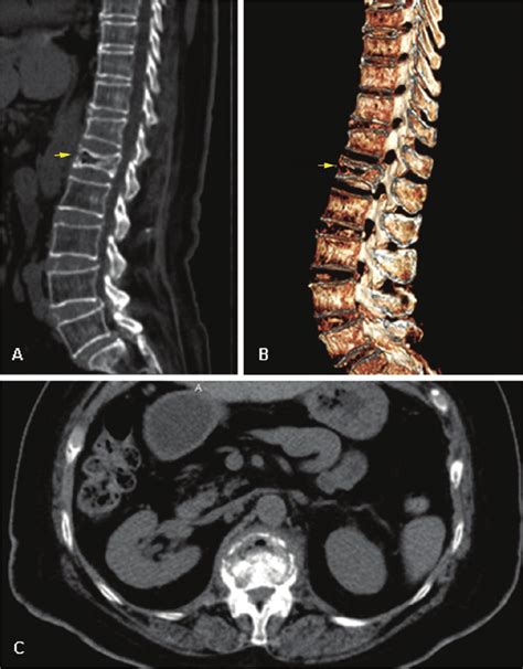 Ct Scan Of The Lumbar Spine With Compression Fracture Of L1 And