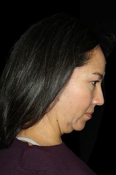 Patient 12510 Facial Fat Grafting Before And After Photos San Diego
