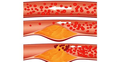 Clogged arteries in different parts of the body can lead to multiple medical conditions, including: Clean your clogged arteries and eliminate bad cholesterol ...