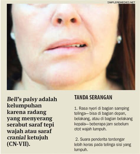 Bell's palsy merupakan kelemahan wajah dengan tipe lower motor neuron yang disebabkan oleh. Kenali Gejala Penyakit Bells Palsy agar Cepat Mendapat ...