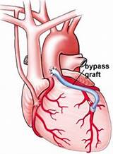 Images of Double Bypass Recovery Time