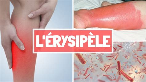 ÉrysipÈle Causes Sypmtomes Complications Traitement Youtube