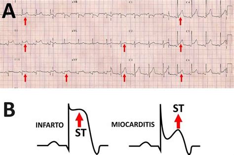 Alterações do st na cardiopatia isquêmica. ¿Cómo es el ECG en las pericarditis?