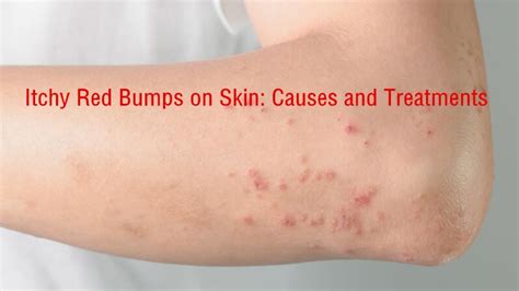Top 19 Small Itchy Bumps On Skin 2022