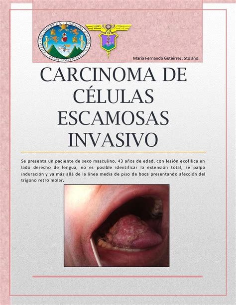 Calaméo Carcinoma De Células Escamosas Invasivo