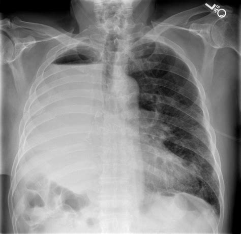 It is necessary for patients to receive help to breathe. Chest Images | Digital Radiography Solutions