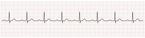 Electrocardiograma Que Muestra Prolongación Pr Que Es Signo De Bloqueo