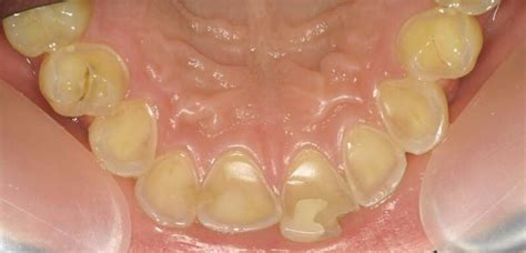 Dental Erosion Damaging Tooth Enamel Darlinghurst Dental