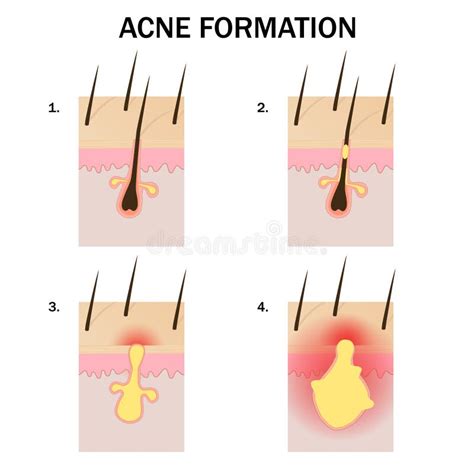 Formation Of Acne Stock Vector Illustration Of Bacterium 68333411