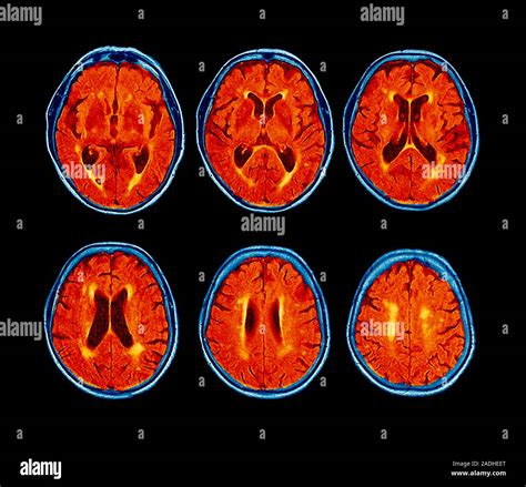 Dementia Coloured Magnetic Resonance Imaging Mri Scans Of The Brain Of A Year Old Patient