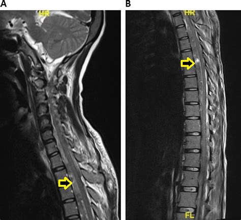 Extensive Spontaneous Spinal Epidural Haematoma When ‘treatment Turned