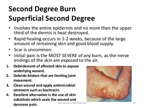 The burned body parts should be elevated above the victim's heart and covered with a moist sterile bandage or a clean damp towel. MURHA.INFO • katso viestiketjua - Pojat kaatoivat lähes ...