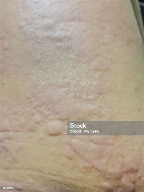 Close Up View Of Cold Urticaria Allergic Rash Symptoms Of Itchy