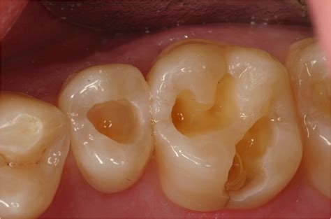 Composite fillings often cause sensitivity, but other types of filling materials cavity prevention starts at home. Ways to Tell if You Have a Cavity