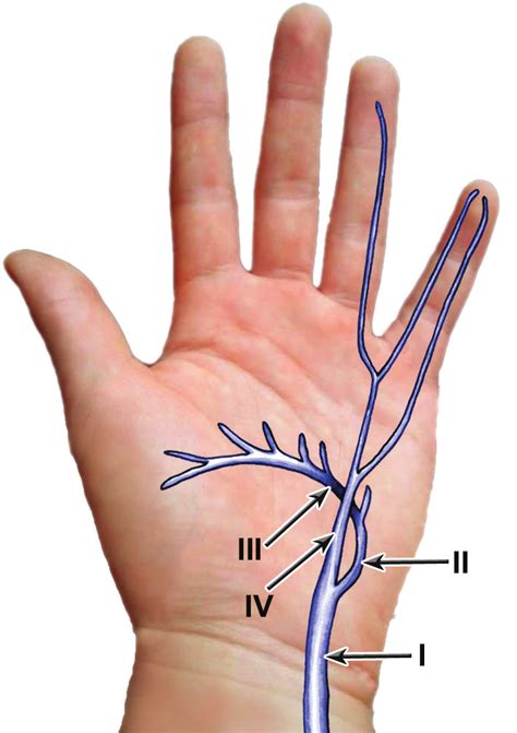 Classification Of Ulnar Nerves Lesions Within Guyons Canal — After