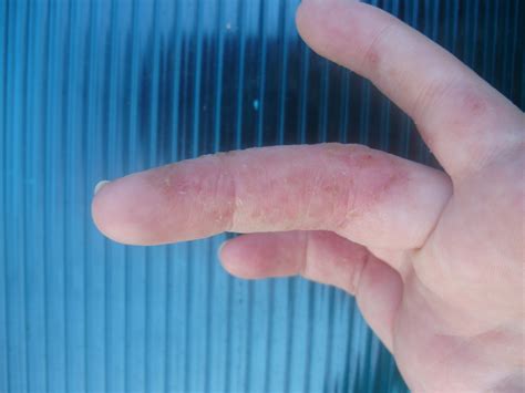 Почему облазит кожа на пальцах рук причины методы лечения