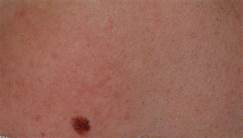 Skin Cancer Apps Can Be Dangerously Wrong Huffpost