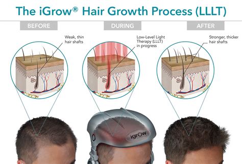 Usually, they start to notice a bald spot on the crown … Hair Loss Treatment in Singapore - What's getting results ...