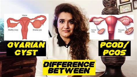 Difference Between OVARIAN CYST PCOD PCOS Polycystic Ovary Syndrome