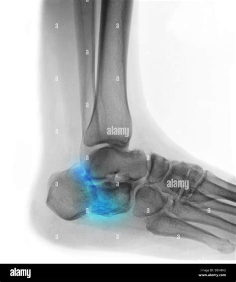 Update More Than 145 Heel Pain After Ankle Fracture Latest Jtcvietnam