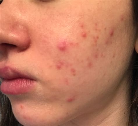 Did Vitamin B12 Give Me Acne — Mixed Makeup