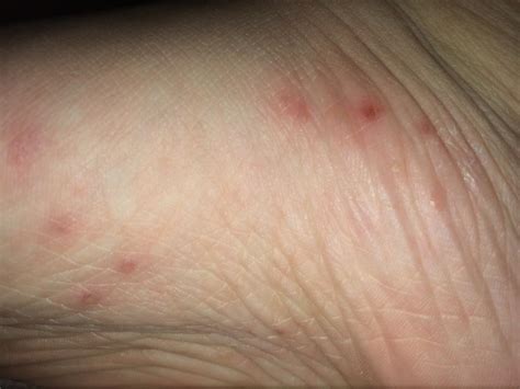 Itchy Blisters On Bottom Of Feet Pictures Photos