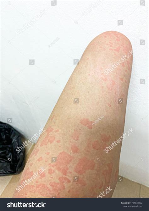 Picture Erythematous Rash Itch On Human Stock Photo 1704638302