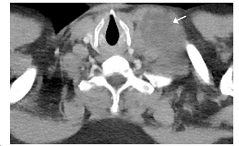 Metastatic Lymph Node Axial Contrast Enhanced Chest Ct Image Shows A