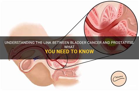 Understanding The Link Between Bladder Cancer And Prostatitis What You Need To Know Medshun