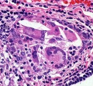 Histopathological Slide Confirmatory Of The Inclusion Cyst Showing
