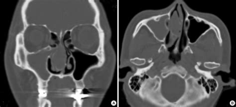 Coronal And Axial Ct Of The Paranasal Sinus Shows The Open I