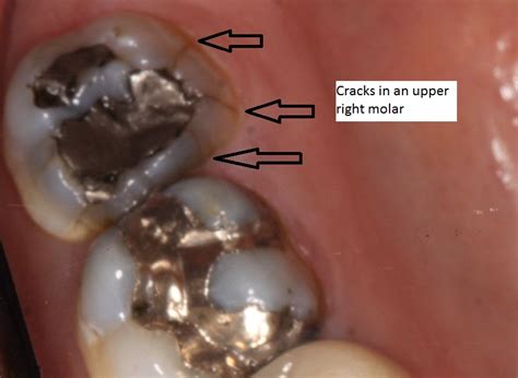 Treatment for a chipped tooth is something that we can typically fix within one day. Broken tooth becomes a smile makeover - Cary Family Dental ...