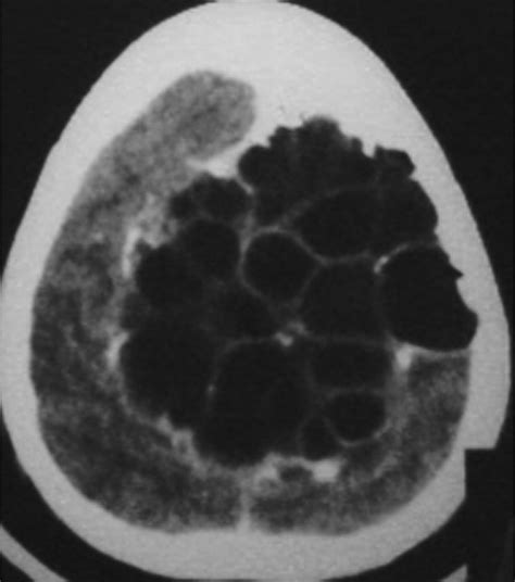 Primary Multiple Calvarial Hydatid Cysts—a Rare Occurrence Journal Of
