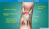 Back Of Knee Tendon Pain Treatment Photos
